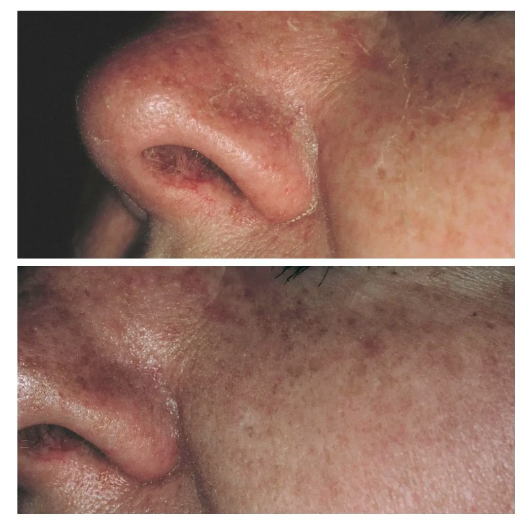 laser vein removal near me