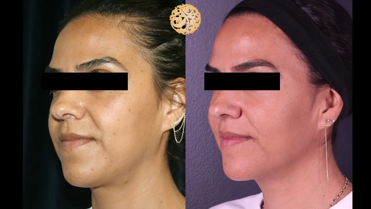 Picosure laser before and after