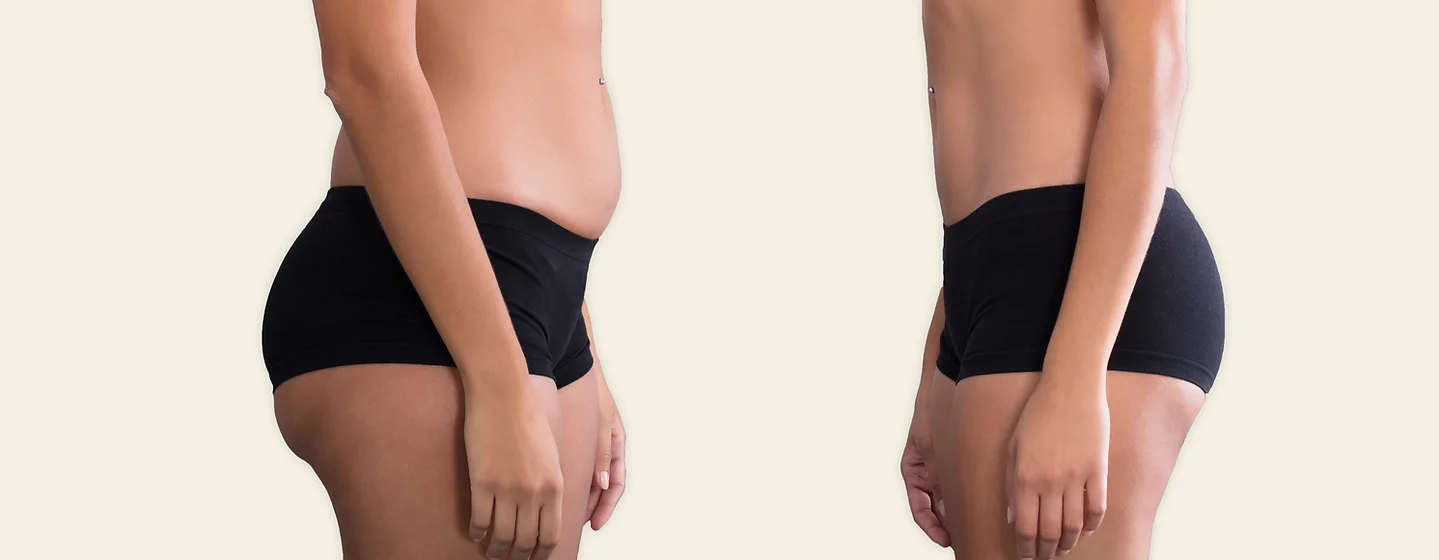 Fat dissolving injections