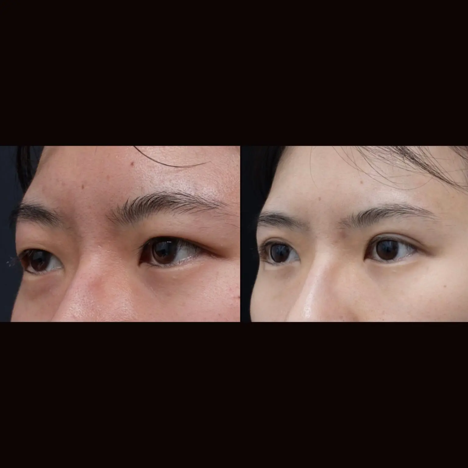 Double eye lid surgery