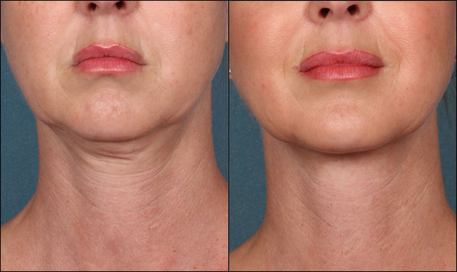Laser skin tightening near me