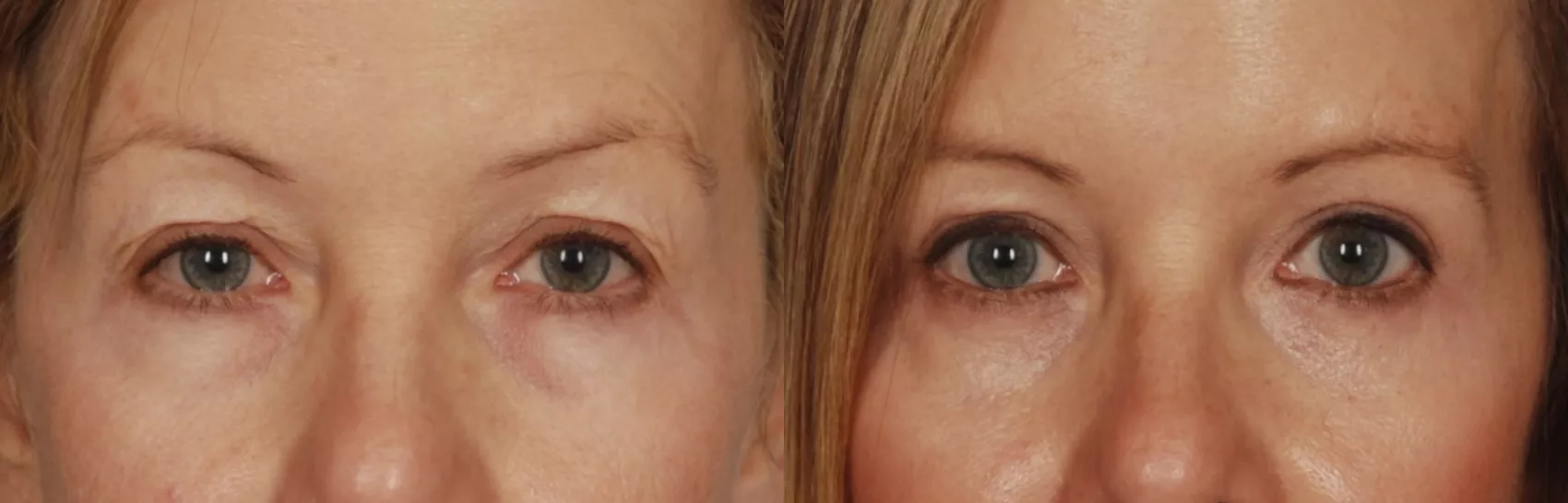 Blepharoplasty surgery near me