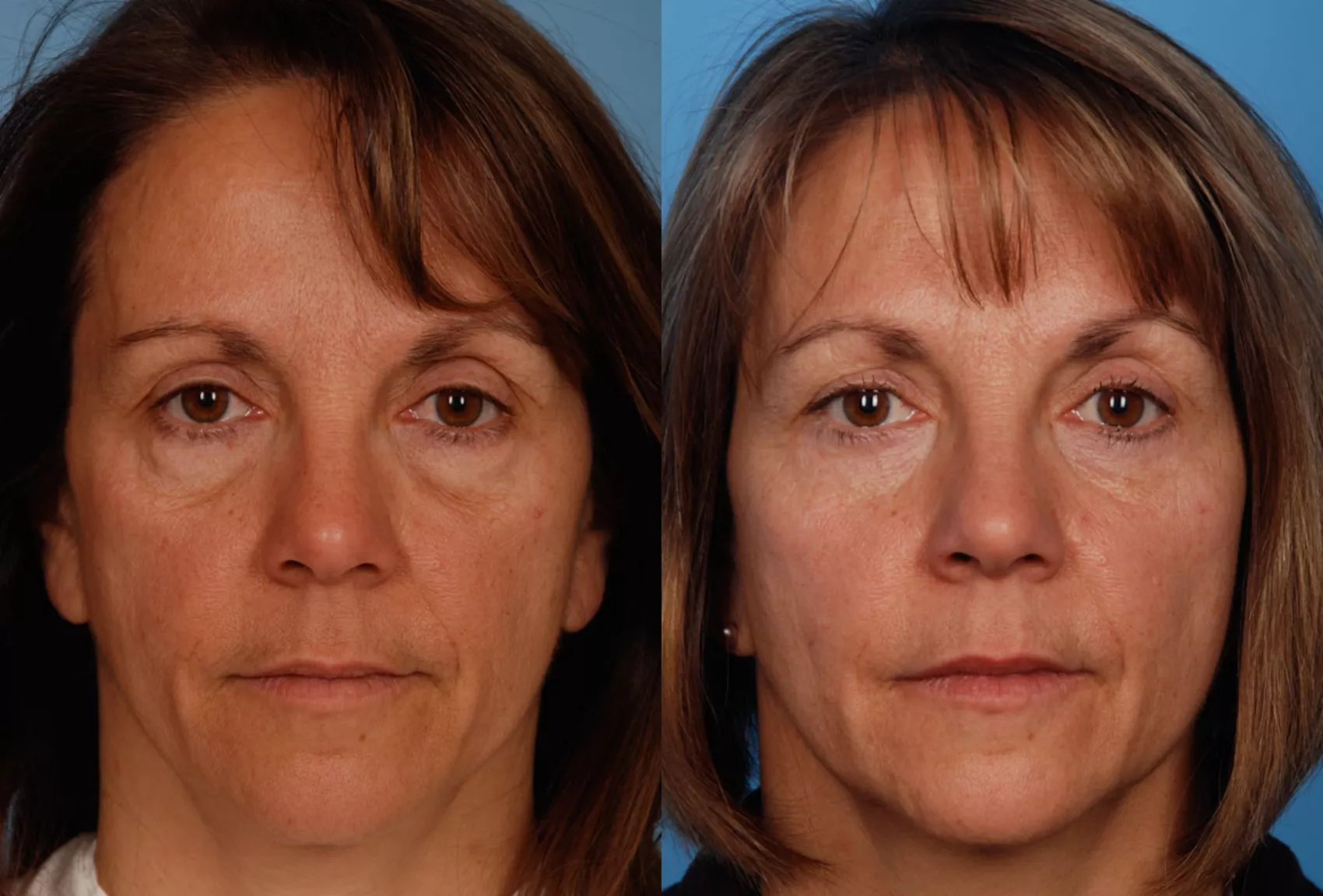 Eyelid surgery blepharoplasty