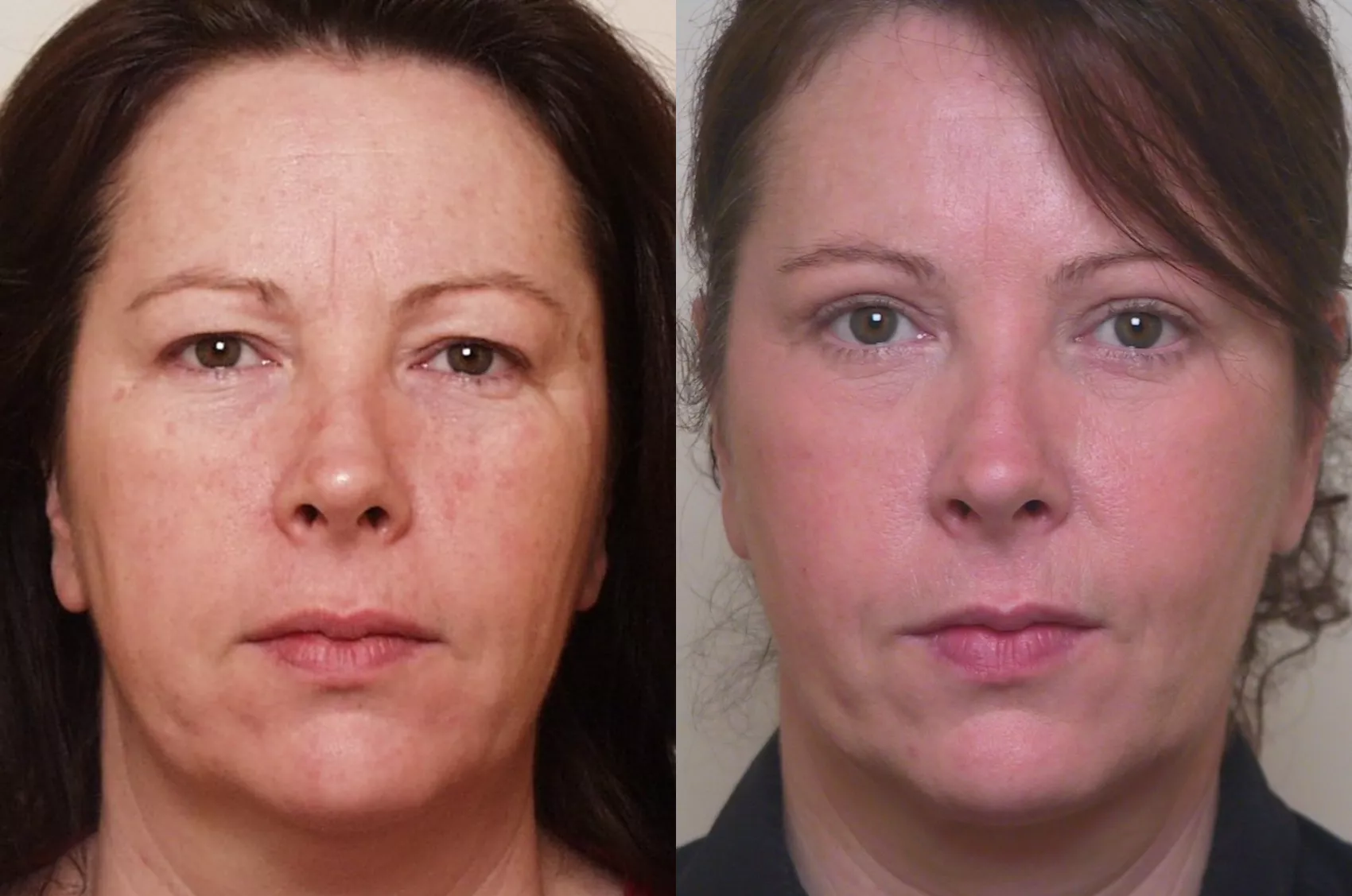 Eyelid surgery blepharoplasty