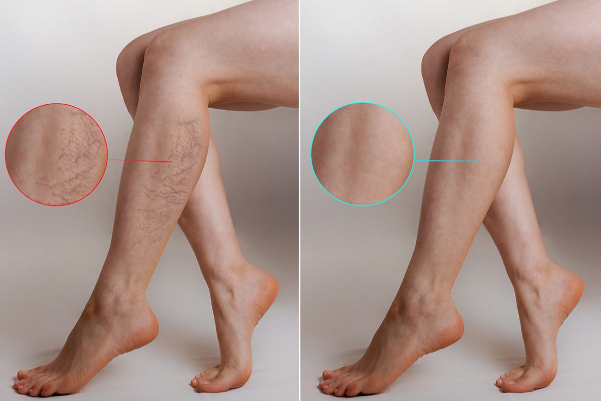 laser vein removal