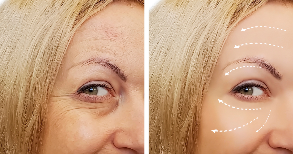 Eye Lift Before and After