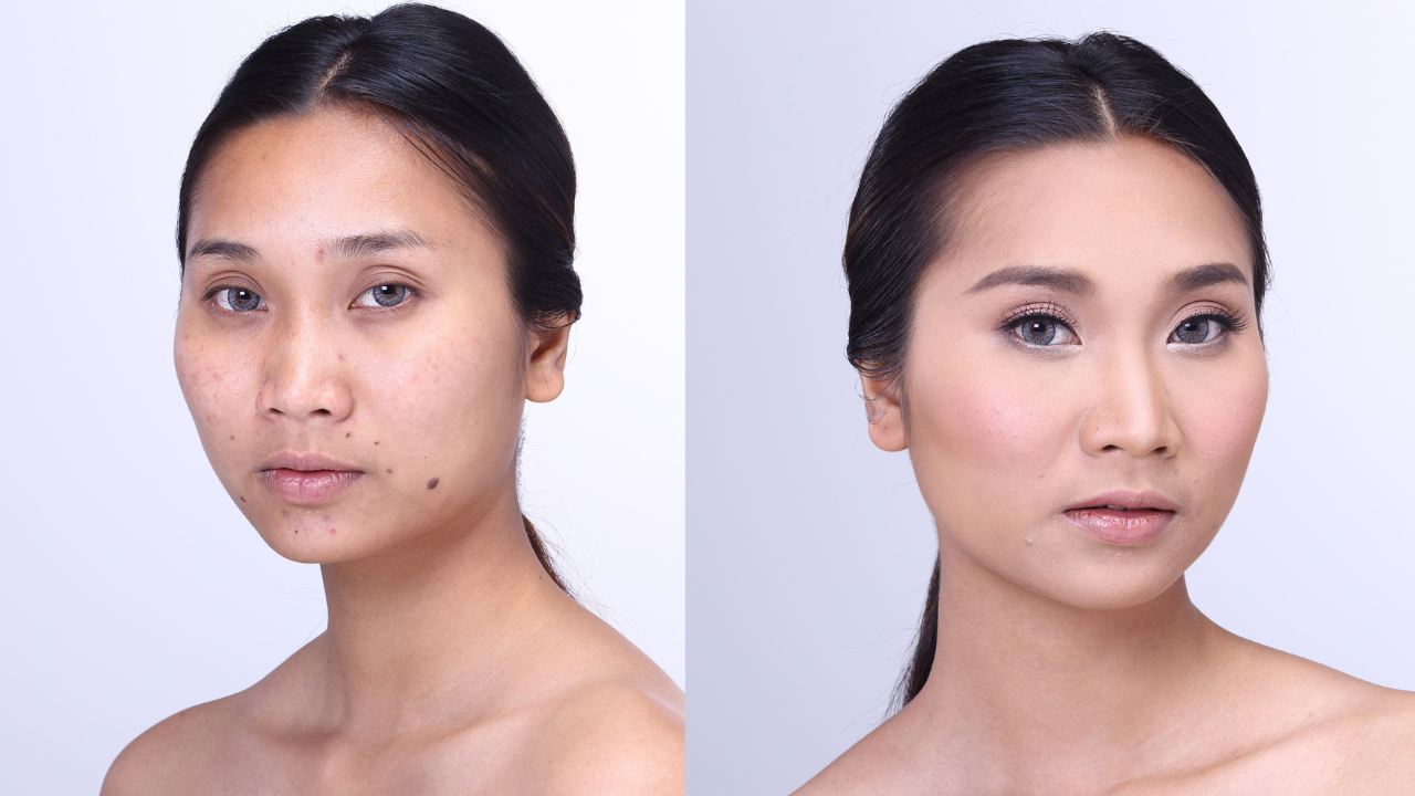 Gliutathione Injections Before and Afrter