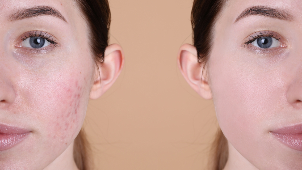 Gliutathione Injections Before and Afrter